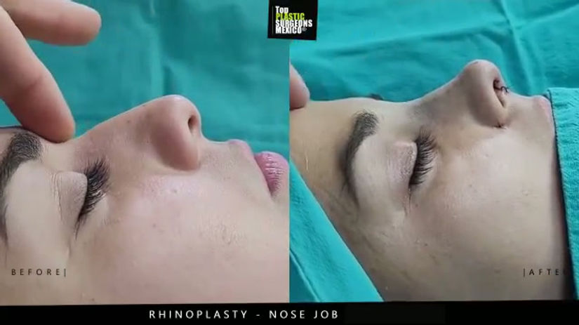 Nose Job - Rhinoplasty in Mexico - TopPlasticSurgeonsMexico 14